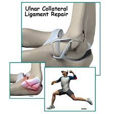 A experimental procedure known as primary repair has emerged as a potential alternative to tommy john surgery, offering a shorter recovery time. Ulnar Collateral Ligament Reconstruction Tommy John Surgery Eorthopod Com