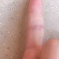 Die aufnahmen zeigen außerdem, ob ein finger zusätzlich auch gebrochen ist. Finger Geprellt Oder Doch Gebrochen