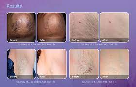 We did not find results for: Permanent Hair Removal Face Back Neck Bikini Body Face Murfreesboro Tn