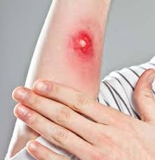 It is advisable that if you find these flat reddish. Bed Bug Bites How Our Pest Control Company Can Help