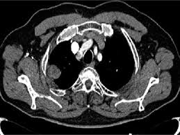 Differentiation of sarcomatoid mesothelioma from other sarcomatoid. Localized Malignant Pleural Mesothelioma Report Of Two Cases Sciencedirect