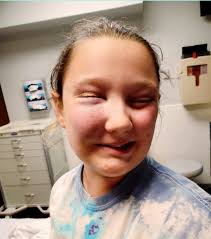 The Necessity of Face Masks in Softball for Preventing Injuries