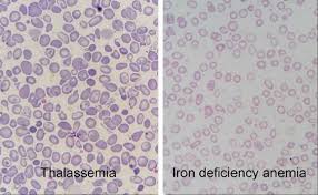 Amount of iron in your blood and body; 28 Haematology Ideas Hematology Medical Laboratory Science Medical Laboratory