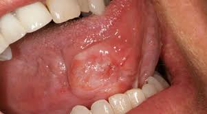 Screeningexternal icon means checking your body for cancer before you have symptoms. Pictures Of Common Dental Problems American Dental Association