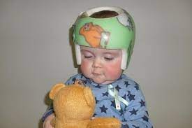 Are Flat Head Syndrome Helmets Safe Madeformums