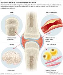 The Complex Riddles Of Rheumatoid Arthritis