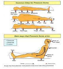 15 Home Remedies For Preventing And Treating Pressure Sores Nursing Skin Assessment Google Search Pressure Ulcer Wound Care Nursing Nurse Life