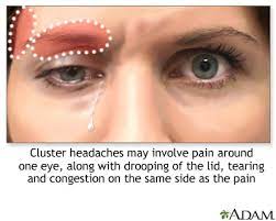 Cluster Headache Medlineplus Medical Encyclopedia