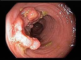 We did not find results for: Index Of Images Thumb C C4 What Does Rectal Cancer Pain Feel Like 1024x768 Jpeg