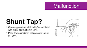 Csf Shunts Gone Bad Brad Sobolewski Md Med Associate Professor Ppt Download