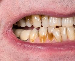 Maybe you would like to learn more about one of these? 5 Tips For Preventing Tooth Stains Enamel Republic Family Dentist