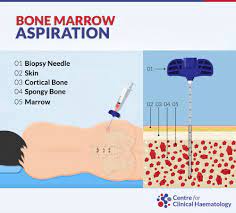 Check spelling or type a new query. Bone Marrow Biopsy And Bone Marrow Aspiration Cfch Centre For Clinical Haematology