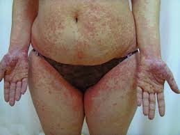 Image result for Secondary Syphilis