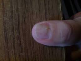 Eiter Im Nagelbett Nagelkrankheiten