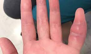 Ever hit your funny bone? Swollen Pinky Finger Was A Rare Sign Of Deadly Tuberculosis For Californian Woman 42 Daily Mail Online