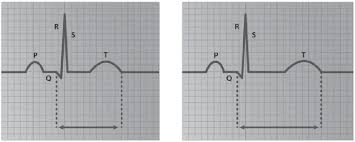 Image result for QT Interval