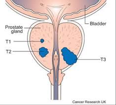 Lung cancer often spreads to lymph nodes first. The Stages Of Prostate Cancer Marie Keating Foundation