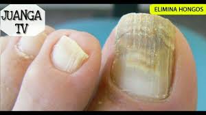 Soñar con uñas significado e interpretación: Remoja Los Pies En Esta Mezcla Por 10 Minutos Y Elimina Los Hongos De Tus Unas Y Pies Para Siempre Youtube