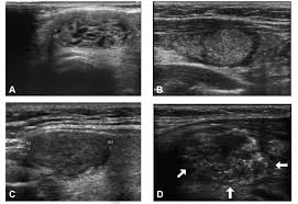 representative images of ti rads and ata systems in thyroid