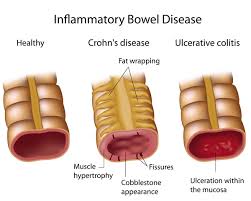 Crohn Disease Genetics Home Reference Nih