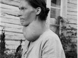 Image result for Goiter