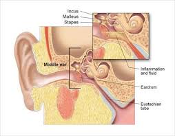 Ear Infections My Doctor Online