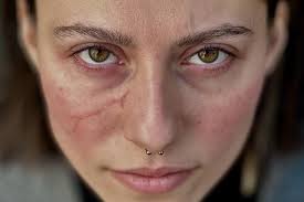 SFX3Prothèses Transferts