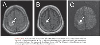Image result for Brain Abscess