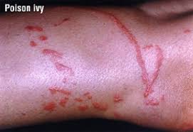 Image result for Contact Dermatitis