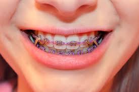 Teeth gaps can be fixed with different dental techniques. Elastics For Braces Rubber Bands In Orthodontics