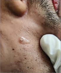 Image result for Demodex brevis