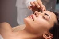 Facial Acupuncture: How It Benefits Skin