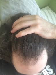 Do some research on these treatments, look at scientific studies, not posts from random guys on hair loss forums. Help 21 Year Old Male Rapidly Balding In 6 Months Hairlosstalk Forums