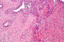 Swallowed food and liquids normally pass through it. Herpes Esophagitis Wikipedia