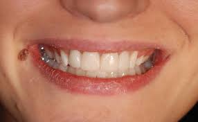 Veneers To Go Myzahnarzt Com