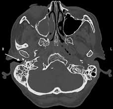 Image result for Necrotizing Otitis Externa