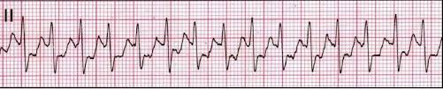 Paroxysmal supraventricular tachycardia (psvt) is a type of irregular heart rhythm or heart arrhythmia where an individual's heart rate becomes excessively fast, starting and stopping suddenly. Paroxysmal Supraventricular Tachycardia Diagnosis And Management