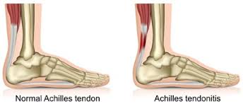 Orthotic devices more commonly help insertional achilles tendonitis (lower in the leg where the tendon inserts into the heel) because the area is more likely to be irritated by certain footwear.21 x. Achilles Tendonitis Tendinopathy Southern Cross Nz