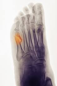 What is a lisfranc fracture? We Broke The Same Bone My Recovery Was A Breeze Hers An Ordeal Why The New York Times