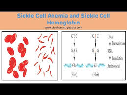 Hemoglobin ss disease, sickle cell anemia. Sickle Cell Anemia Biochemistry Sickle Cell Anemia Youtube