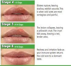 However, if a baby does catch the cold sore virus, called herpes simplex, it can be very dangerous. Herpes Therapy