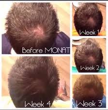 But as you know, this inflammation can also lead to follicles clogged with sebum and other substances. How To Regrow Hair That Has Closed Pores Quora