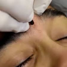 As a leading laser hair removal facility in south texas including: Eyebrows Permanenthairremoval Electrolysis Hair Removal Permanent Electrolysis Hair Removal Hair Removal
