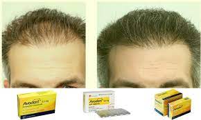 My question is can i still try to conceive while im taking avodart. Avodart Dutasteride Davinci Omen Best High Quality Gear Buy Winstrol Online