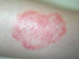 Und es soll uns als schutzbarriere dienen. Ringelflechte Tinea Corporis Deximed