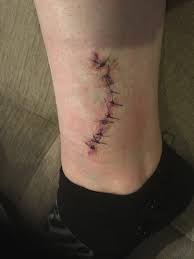 Check spelling or type a new query. Tattoo Surgical Excision Dr Gregoris Review Realself