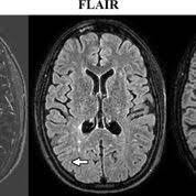¿qué es la esclerosis múltiple? La Resonancia Magnetica Sin Contraste Monitoriza De Manera Efectiva A Los Pacientes Con Esclerosis Multiple Rm Medimaging Es