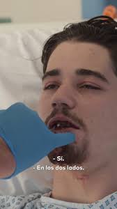 Tras un accidente con un patinete eléctrico, Jack de 23 años se ha partido  los dientes y se ha destrozado la mandíbula y los labios🤯, 💉No te pierdas  el estreno de ‘Cirugía Facial’ esta noche a las ...