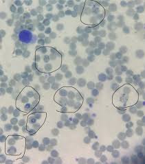 Image result for Reticulocyte Count