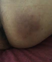 Manchas Negras Y Piel Gruesa